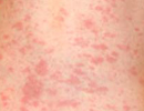 Roseola